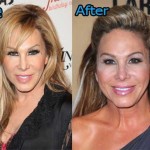 Adrienne Maloof before and after plastic surgery 150x150