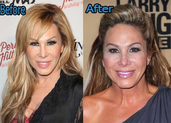 Adrienne Maloof before and after plastic surgery