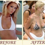 Tara Reid before and after plastic surgery 150x150