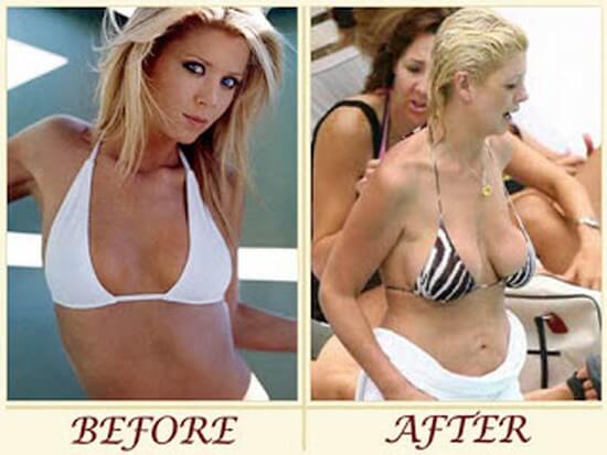 Tara Reid before and after plastic surgery