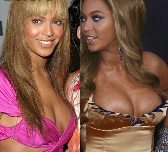 Beyonce before and after boob job