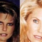 Christie Brinkley plastic surgery before and after 150x150