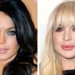 Lindsay Lohan plastic surgery pictures 150x150