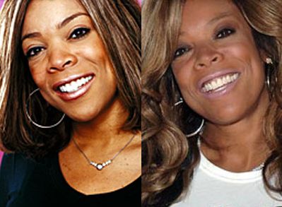 Wendy Williams plastic surgery before and after
