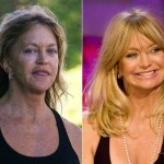 Goldie Hawn before and after plastic surgery 150x150