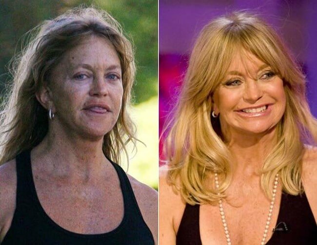 Goldie Hawn before and after plastic surgery