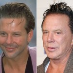 Mickey Rourke before and after plastic surgery 150x150