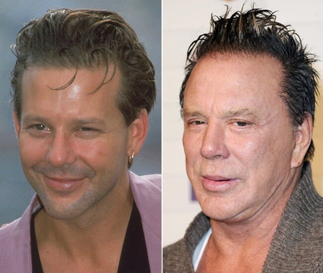 Mickey Rourke before and after plastic surgery