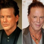 Mickey Rourke botox facelift surgery before and after 150x150