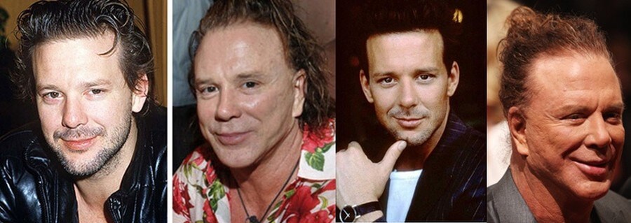 Mickey Rourke plastic surgery before and after