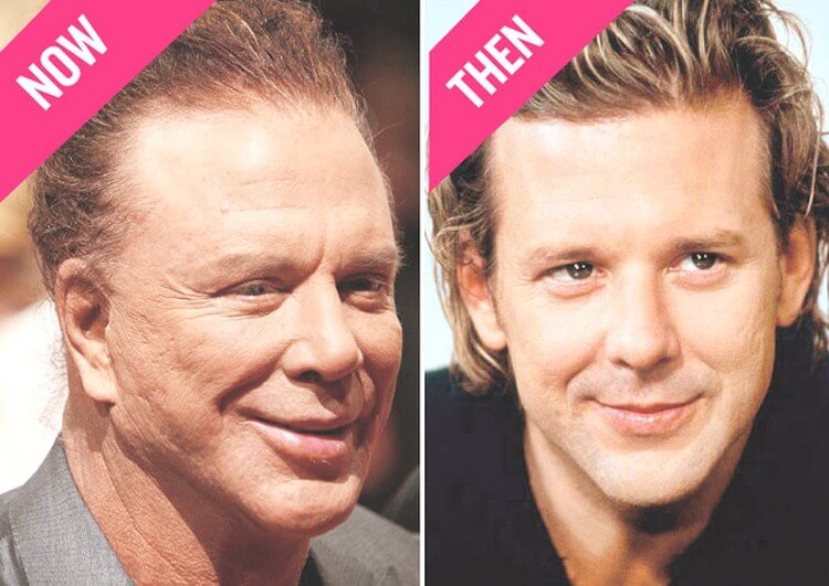 Mickey Rourke plastic surgery now and then