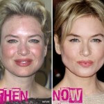 Renee Zellweger before and after plastic surgery 150x150