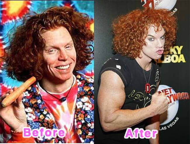 Carrot Top before and after browlift and botox injections