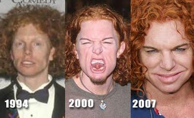 Carrot Top before and after plastic surgeries