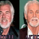 Kenny Rogers before and after 150x150