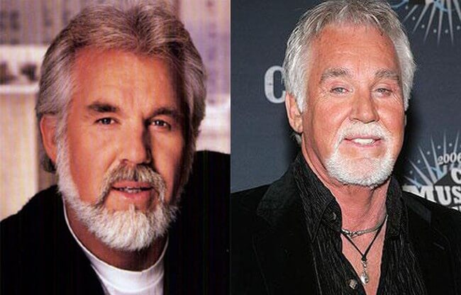 Kenny Rogers before and after facelift plastic surgery.