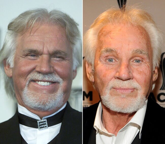 Kenny Rogers before and after plastic surgery