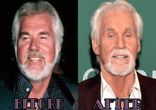 Kenny Rogers before and after