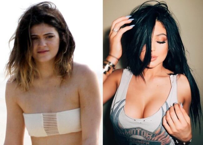 Did Kylie Jenner had breast implants plastic surgery