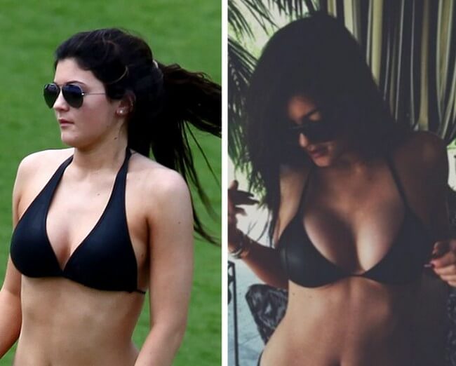 Kylie Jenner before and after breast implants plastic surgery