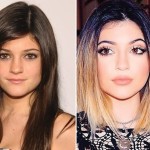 Kylie Jenner before and after nose job and lip augmentation 150x150