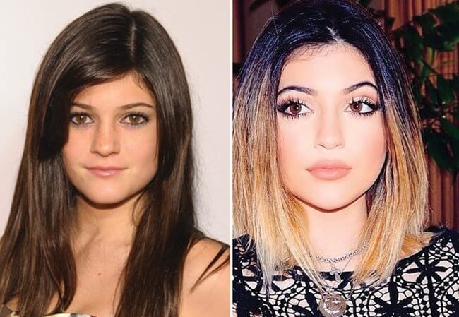 Kylie Jenner before and after nose job and lip augmentation