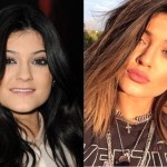 Kylie Jenner plastic surgery before and after pictures 150x150