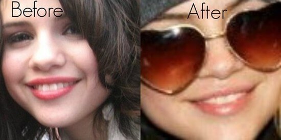 Selena Gomez nose job surgery before and after