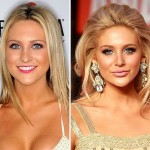 Stephanie Pratt before and after lip implants 150x150