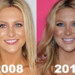 Stephanie Pratt before and after plastic surgery 150x150