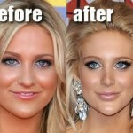 Stephanie Pratt plastic surgery before and after 150x150