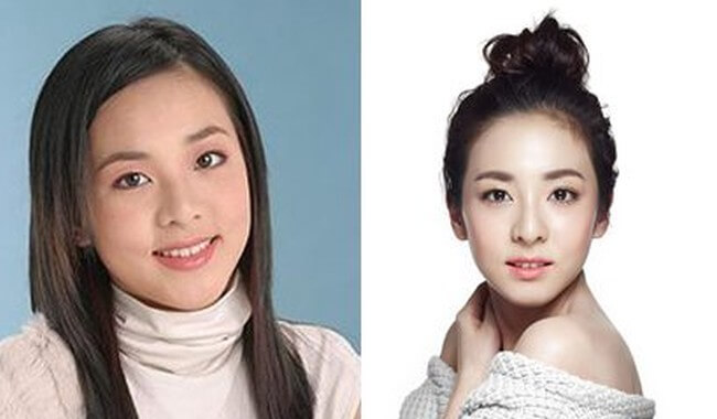 Sandara Park before and after nose job surgery