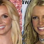 britney spears lip injections before and after 150x150