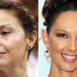 Ashley Judd Cosmetic Procedures 150x150