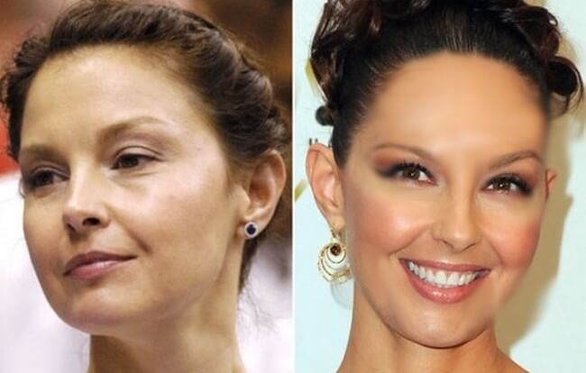Ashley Judd Cosmetic Procedures