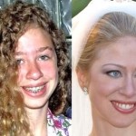 Chelsea Clinton Before And After Plastic Surgery Nose Job 150x150
