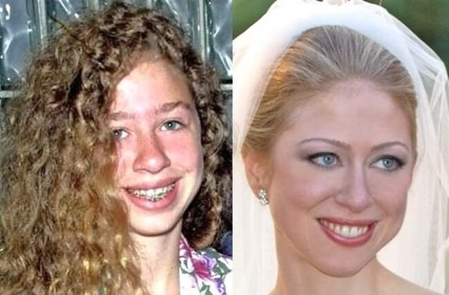 Chelsea Clinton Before And After Plastic Surgery Nose Job
