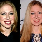 Chelsea Clinton Fuller Lips And Altered Chin 150x150