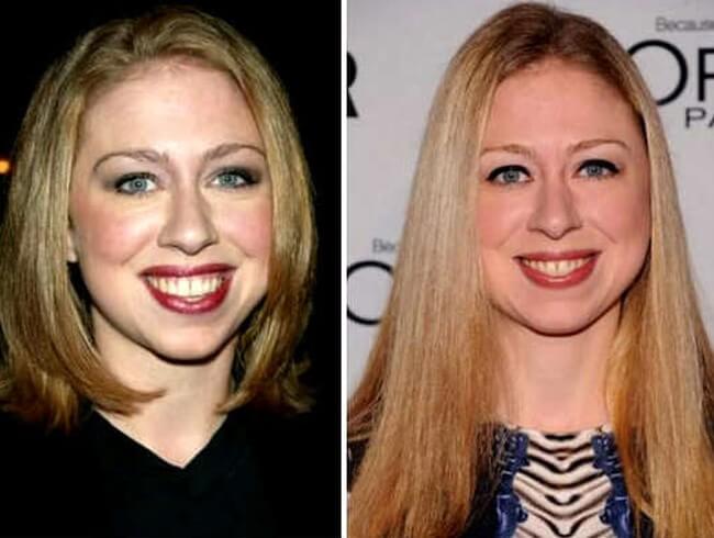 Chelsea Clinton Fuller Lips And Altered Chin