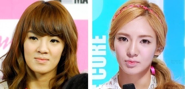 Hyoyeon Before And After Plastic Surgery