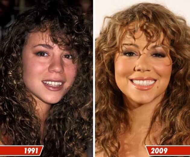 Mariah Carey Before And After Cheek Augmentation