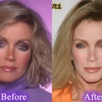 Donna Mills Plastic Surgery Before And After Botox Injections 150x150