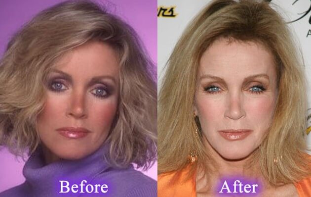 Donna Mills Plastic Surgery Before And After Botox Injections