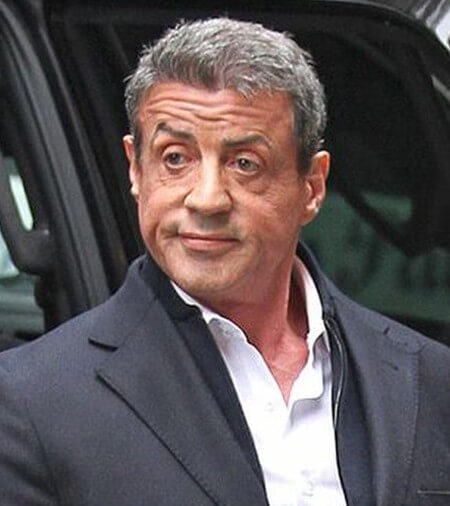 Sylvester Stallone After Botox Injections