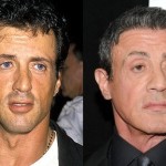 Sylvester Stallone Before And After Plastic Surgery 150x150