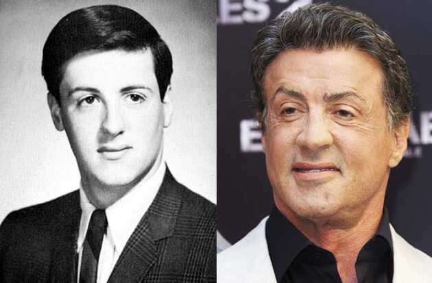Sylvester Stallone Plastic Surgery Brow Lifting