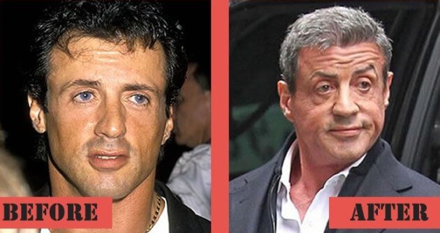 Sylvester Stallone Plastic Surgery Tighter Jaw Line