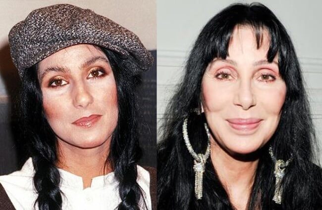 Cher Before and After Photos