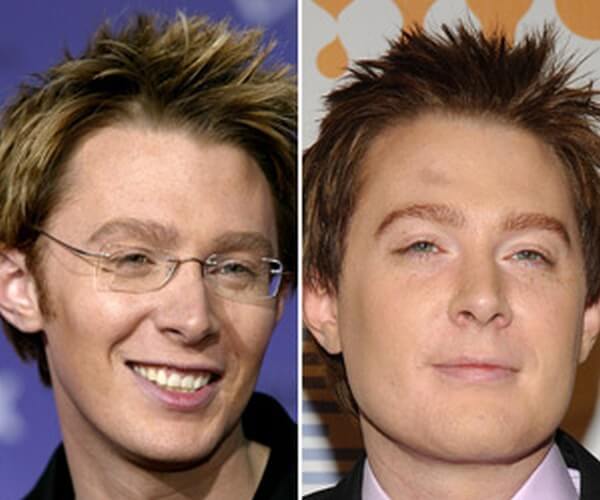 Clay Aiken plastic surgery before and after
