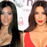 Kim Kardashian before after plastic surgery 150x150